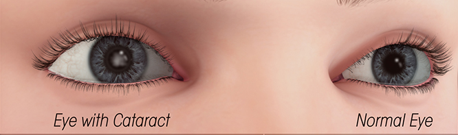 Cataracts